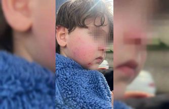 Kreşe bıraktığı çocuğunu darp edilmiş halde aldı