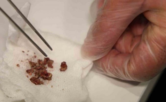 Elazığ’da estetik ameliyatta şaşırtan olay, burundan taş çıktı